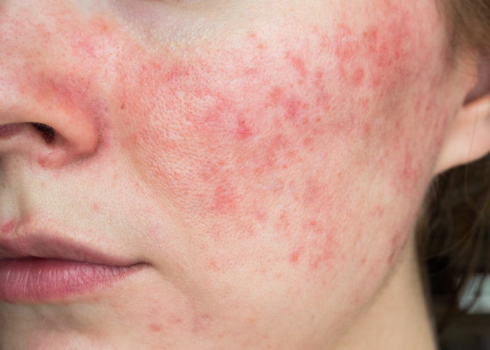kvinde der lider af rosacea