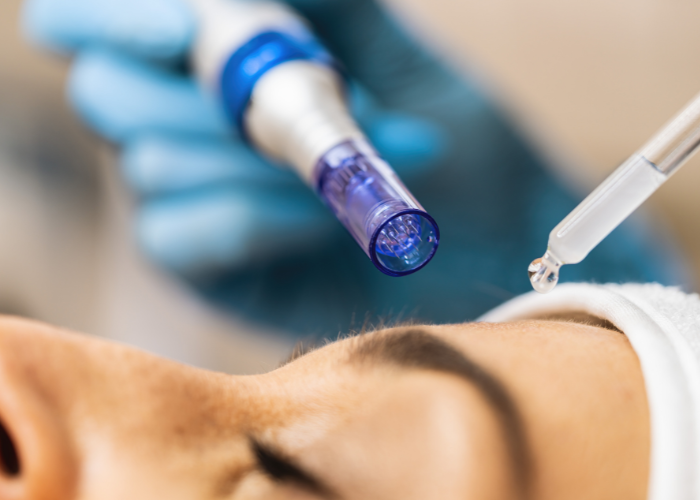 Kvinde der får lavet ansigtsbehandling med mesoterapi